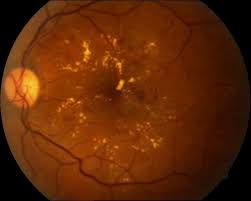Obraz dna oka w retinopatii cukrzycowej nieproliferacyjnej: wysięki twarde, mikrowłośniaki, krwotoczki.
